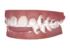 Unsichtbare Lippen Stoßstange