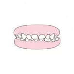 Deep overbite