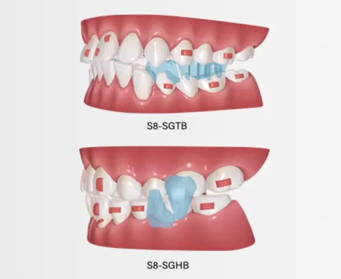 Unterkiefer-Reposition ierungs gerät für den Unterkiefer-Fortschritt
