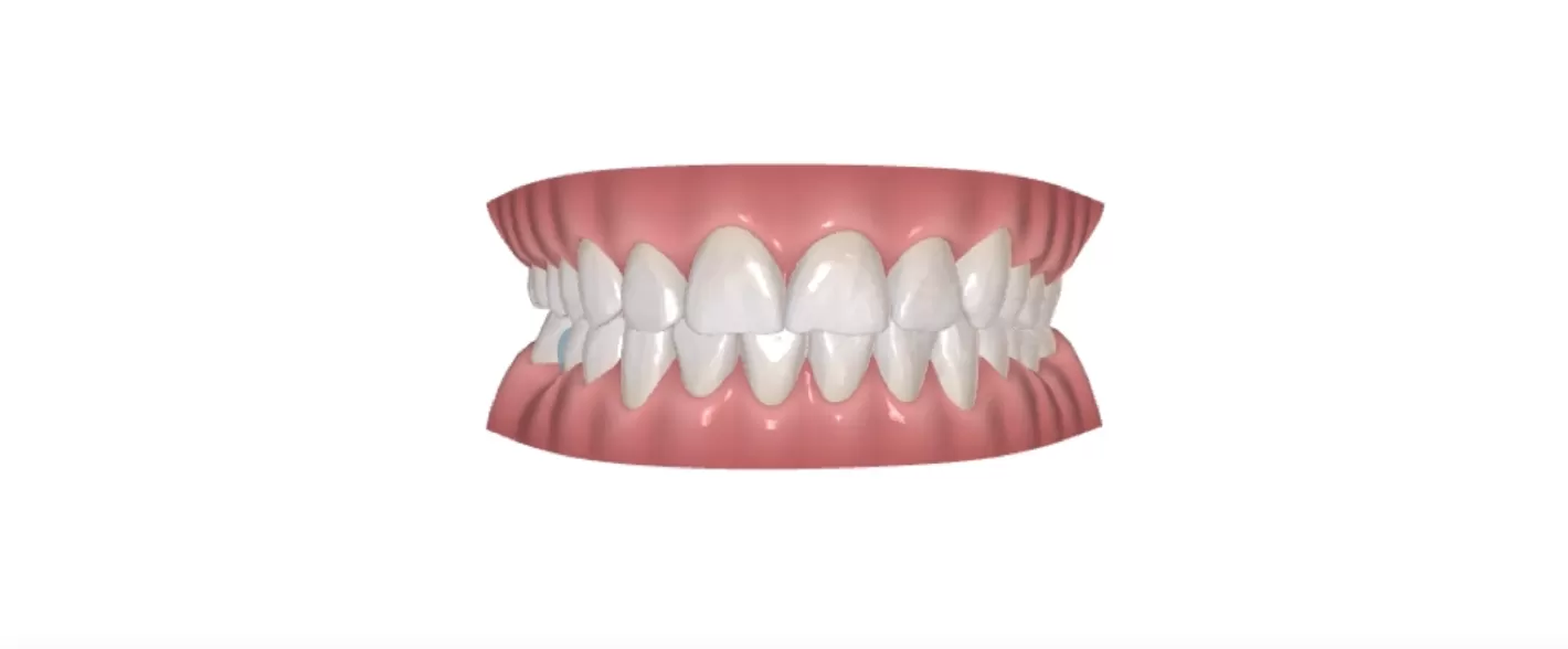 3D-Simulations behandlungs plan. Kreuz biss