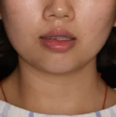 Gesichts fotos vor der Behandlung