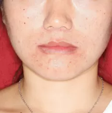 Gesichts fotos vor der Behandlung