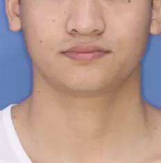 Gesichts fotos vor der Behandlung