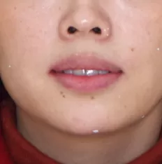 Gesichtsfotos vor der Behandlung