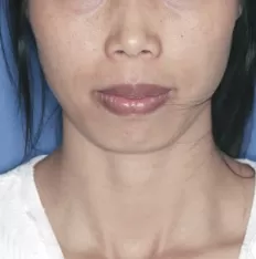 Gesichtsfotos vor der Behandlung