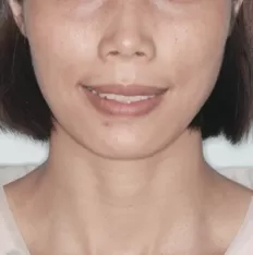 Gesichts fotos vor der Behandlung