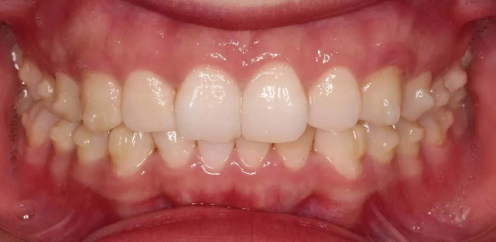 S8-SGTB Unterkieferprotrusion