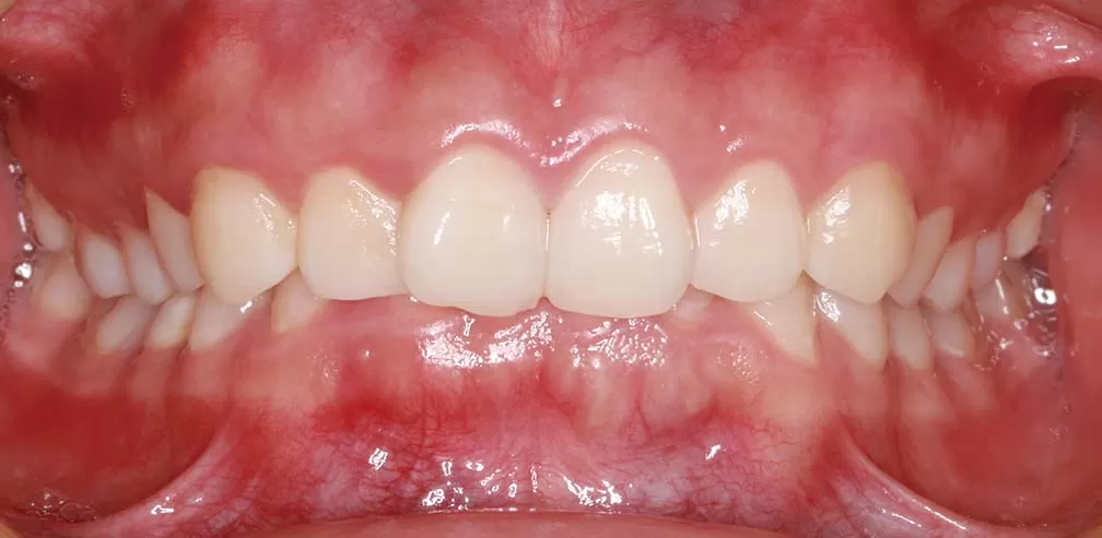 S8-SGTB Unterkieferprotrusion