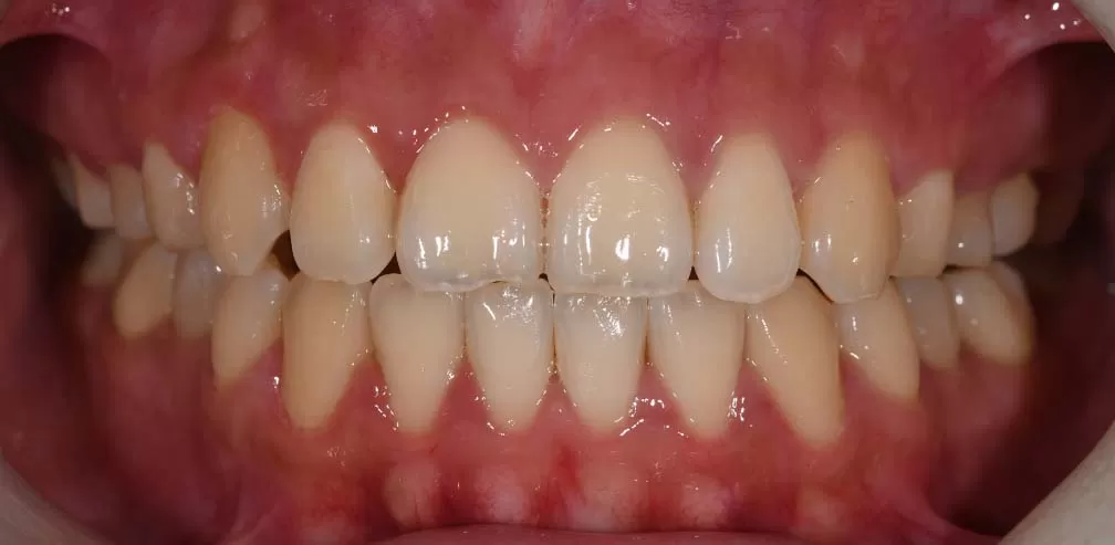 S8-SGHB korrekter vorderer Openbite