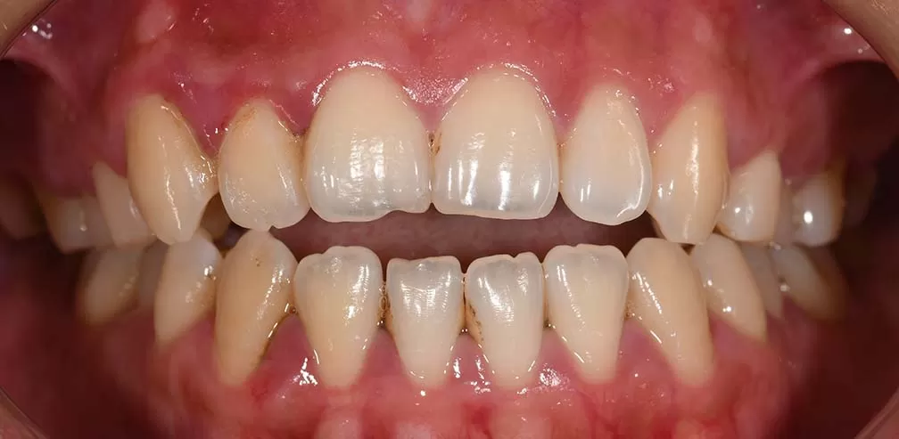 S8-SGHB korrekter vorderer Openbite