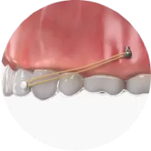 Traktion zwischen Vorder-und Implantat schraube